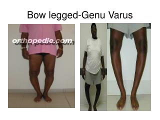 Bow legged-Genu Varus