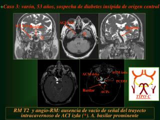 Caso 3: varón, 53 años, sospecha de diabetes insípida de origen central