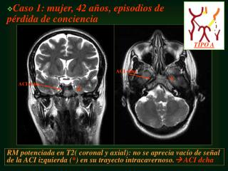 Caso 1: mujer, 42 años, episodios de pérdida de conciencia