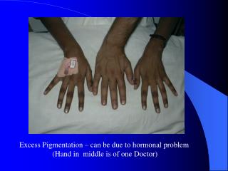Excess Pigmentation – can be due to hormonal problem (Hand in middle is of one Doctor)