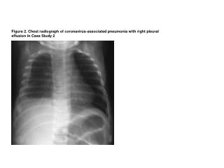 Figure2_Heugel-etal-CoV-associated-pneumonia
