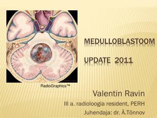 Medulloblastoom Update 2011