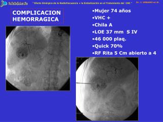 COMPLICACION HEMORRAGICA