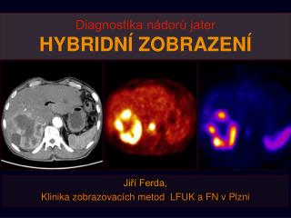 Diagnostika nádorů jater HYBRIDNÍ ZOBRAZENÍ