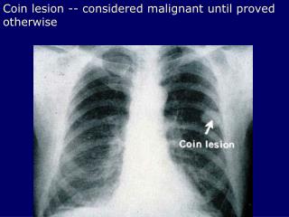 Coin lesion -- considered malignant until proved otherwise