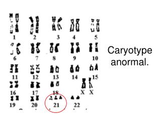 Caryotype anormal.