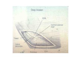 Posterolateral Rotatory Instability (PLRI)