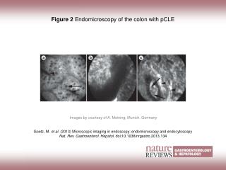 Figure 2 Endomicroscopy of the colon with pCLE