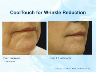 CoolTouch for Wrinkle Reduction