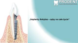 „ Implanty Ankylos – zęby na całe życie “