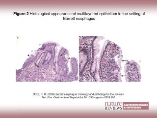 Figure 2 Histological appearance of multilayered epithelium in the setting of Barrett esophagus