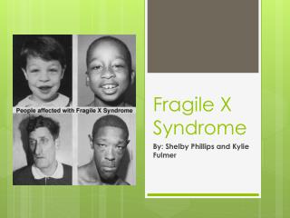 Fragile X Syndrome