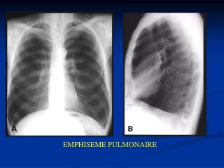 EMPHISEME PULMONAIRE