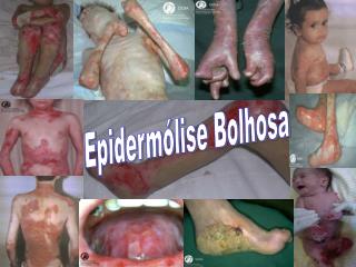 Epidermólise Bolhosa