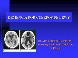 DEMENCIA POR CUERPOS DE LEWY