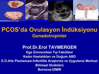 PCOS’da Ovulasyon İndüksiyonu Gonadotropinler