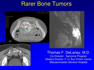 Rarer Bone Tumors