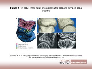 Figure 4 HR‑pQCT imaging of anatomical sites prone to develop bone erosions