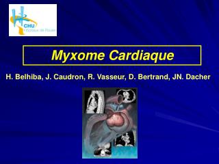 Myxome Cardiaque