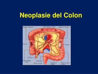 Neoplasie del Colon