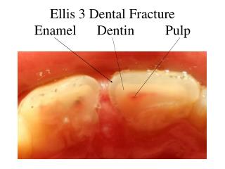 Ellis 3 Dental Fracture Enamel Dentin Pulp