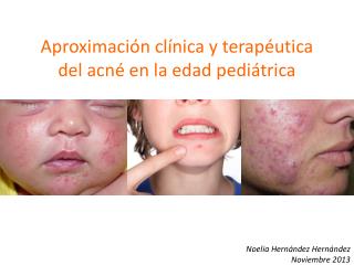 Aproximación clínica y terapéutica del acné en la edad pediátrica