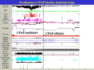 Eredményes CPAP titrálás áttekintő képe