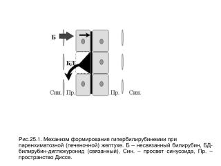 Рис.25.1. Механизм формирования гипербилирубинемии при