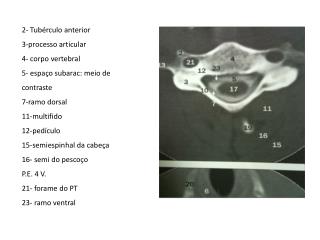 2- lig. l ongit. a nterior 3- veias basivertebrais 5- C7 6- T7 13- lig. F lavo