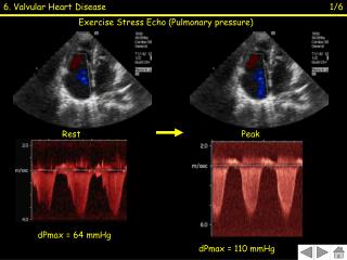 Exercise Stress Echo (Pulmonary pressure)