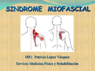 SINDROME MIOFASCIAL