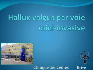 Hallux valgus par voie mini-invasive