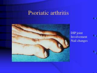 Psoriatic arthritis