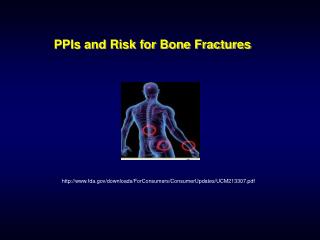 PPIs and Risk for Bone Fractures