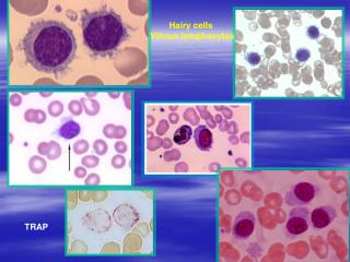 Hairy cells Villous lymphocytes