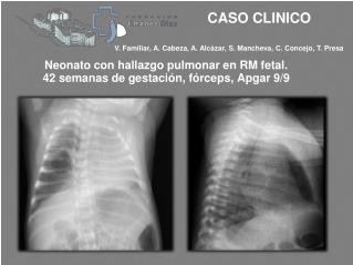 Neonato con hallazgo pulmonar en RM fetal. 42 semanas de gestación, fórceps, Apgar 9/9
