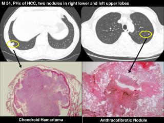 M 54, PHx of HCC, two nodules in right lower and left upper lobes