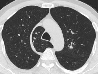 Anthracofibrotic nodule with calcification