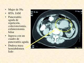 Mujer de 59a HTA. IAM Pancreatitis aguda de repetición, colecistectomía, esfinterotomía biliar