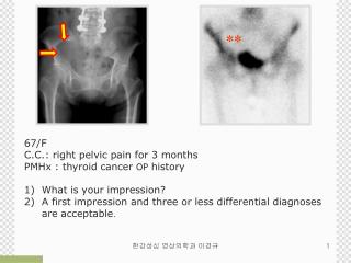 67/F C.C.: right pelvic pain for 3 months PMHx : thyroid cancer OP history