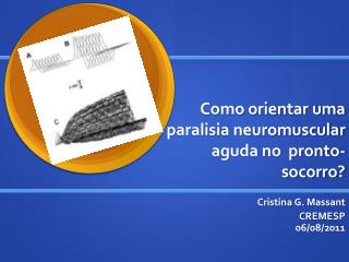 Como orientar uma paralisia neuromuscular aguda no pronto-socorro?