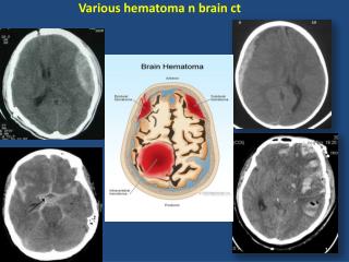 Various hematoma n brain ct