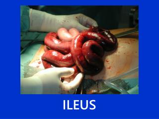 ILEUS