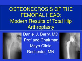 OSTEONECROSIS OF THE FEMORAL HEAD: Modern Results of Total Hip Arthroplasty