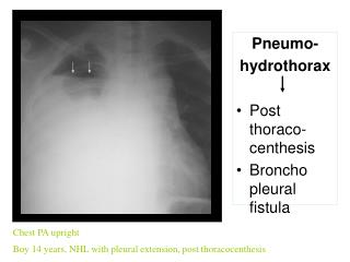 Chest PA upright Boy 14 years, NHL with pleural extension, post thoracocenthesis