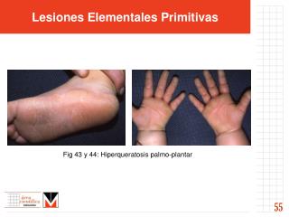 Lesiones Elementales Primitivas