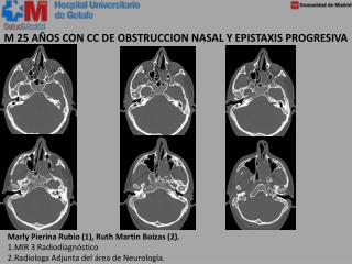 M 25 AÑOS CON CC DE OBSTRUCCION NASAL Y EPISTAXIS PROGRESIVA