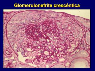 Glomerulonefrite crescêntica