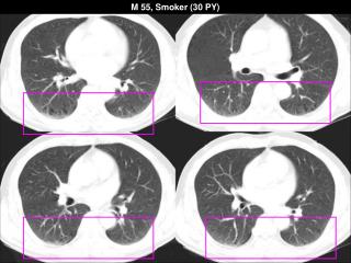 M 55, Smoker (30 PY)