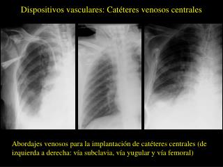 Dispositivos vasculares: Catéteres venosos centrales